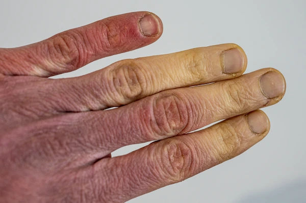 raynauds disease